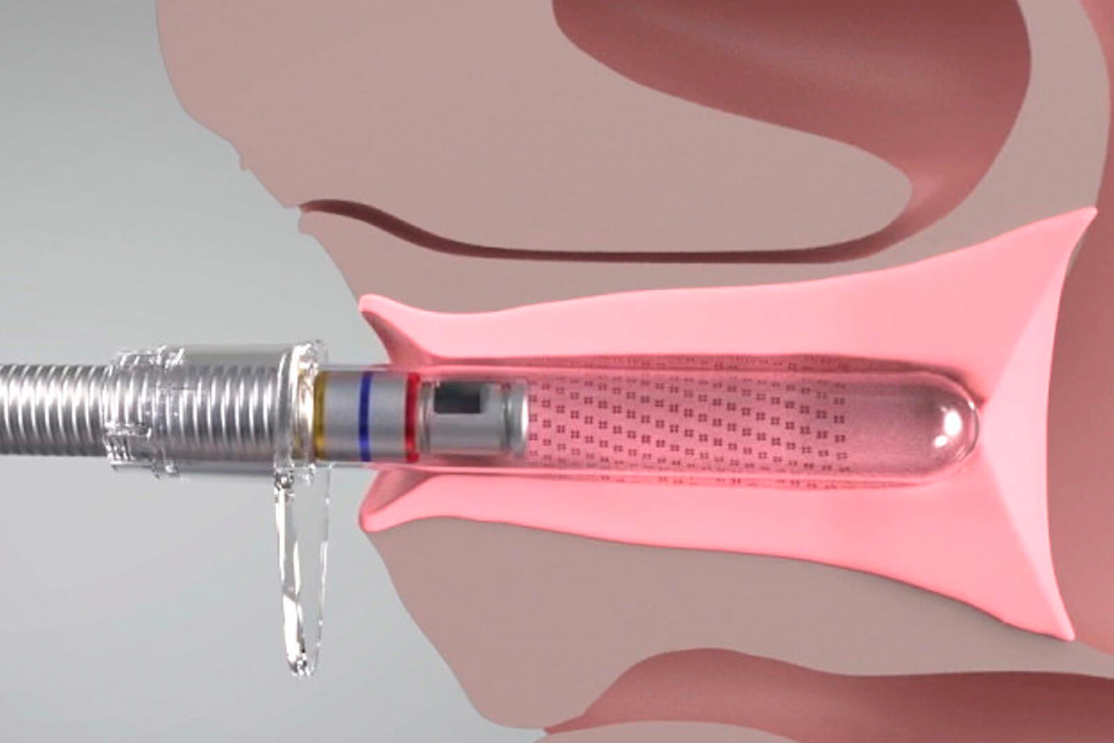 Diva Laser Vaginal Therapy Haydel Dermatology 8598